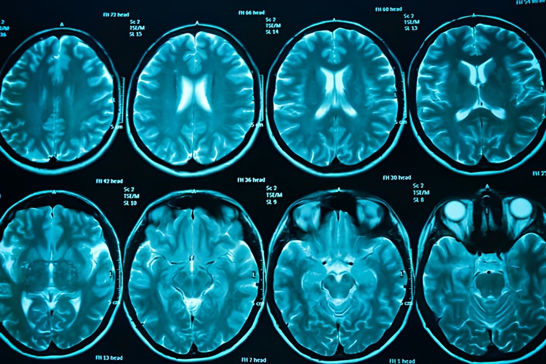 Brain Tumor Warning Signs — 10 Symptoms That Need Immediate Attention